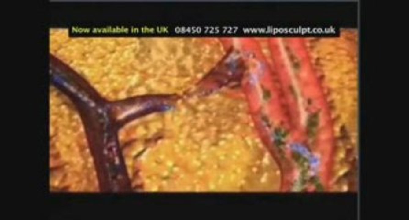 Weight loss pills alternative in London using ultrasound