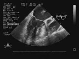 Echo Film of a Torn Mitral Valve