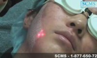 Laser Acne Removal Asian Skin Type