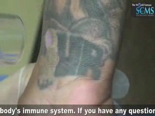 Laser Tattoo Removal Wrist