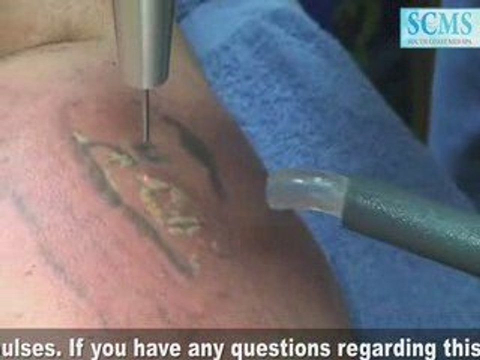 Laser Tatto Removal Back