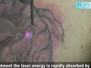 Laser Tatto Removal Back