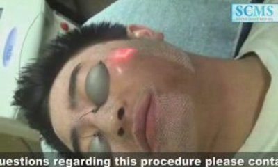 Laser Acne Scar Removal