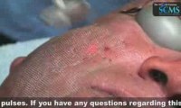 Laser Acne Scar Removal