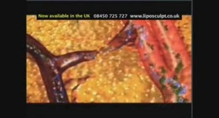 Weight loss pills alternative in London using ultrasound
