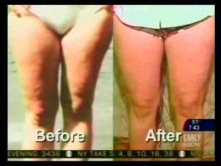 Accent Cellulite Treatment in New York City