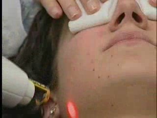 Acne Scar Removal Treatment - Dr. Goldberg in NJ