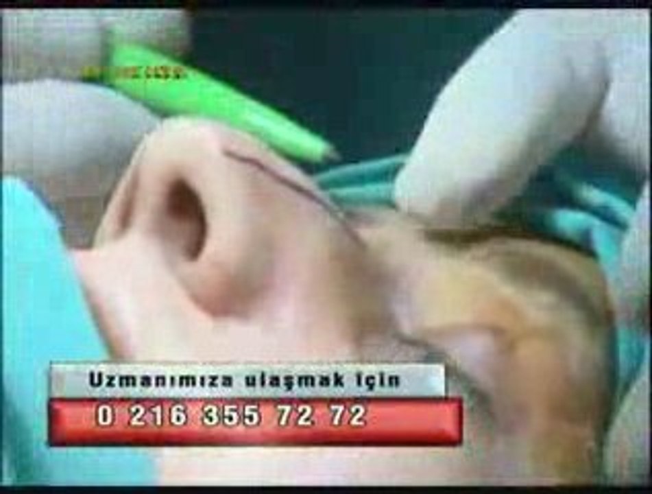 burun estetigi hakkanda bilgi