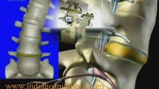Spine Surgery,Spine Surgery India,India Cost Effective Spine
