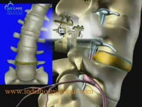 Spine Surgery,Spine Surgery India,India Cost Effective Spine