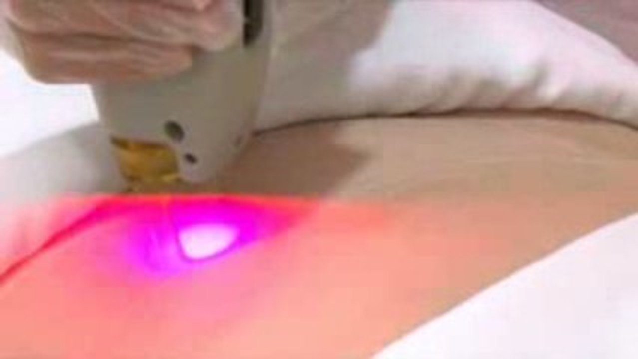 DEPILACION LASER MONTE VENUS ALEJANDRINA CATALAN