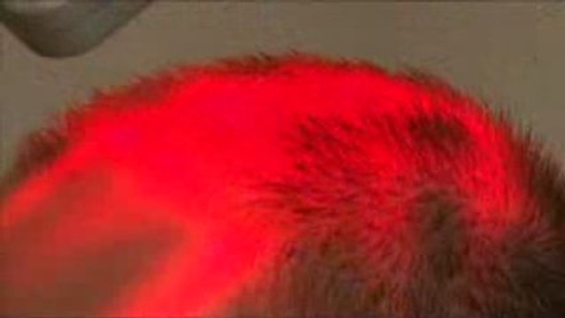 TRATAMIENTOS CAPILARES LASER DIODO CATALAN