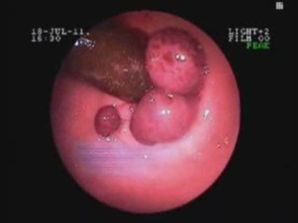 Cure sus Hemorroides Internas - curarlashemorroidesen48hs