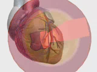 Heart Attack: Causes and Prevention ❤️ - thumbnail