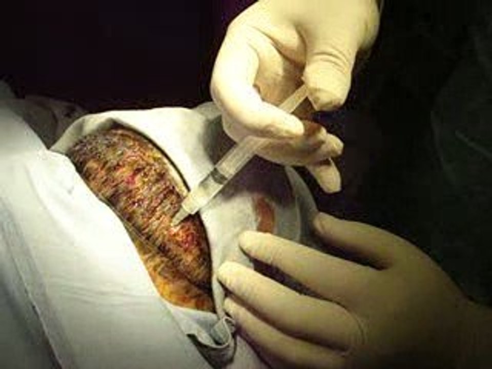 زرع الشعر بالطرق الحديثة-تجميل-زراعة الشعر في الحاجب الشنب-ا
