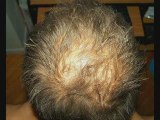Baldness treatments ,hair loss baldness treatment in UK USA
