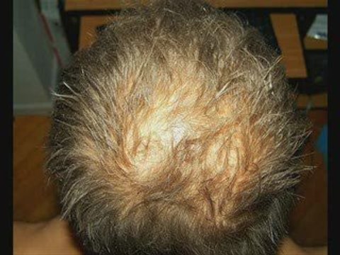 Baldness treatments ,hair loss baldness treatment in UK USA