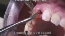 SENSATIONAL: IMPLANT WITHOUT DRILLING AND ABSOLUTE FLAPLESS 
