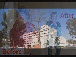 Affordable Lap Band Surgery Ft. Myers Fl