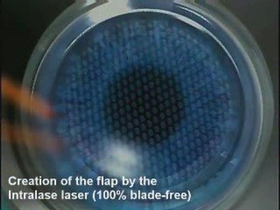 Vision Correction Surgery Using Full Laser