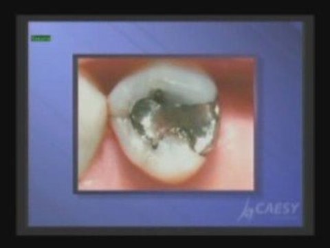 Dental fillings | cosmetic dentistry |Glendale | Dr. Sahabi