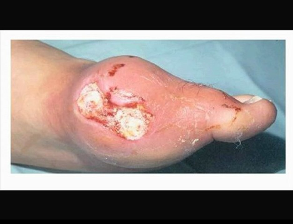 Gout Treatment-Gout Remedies