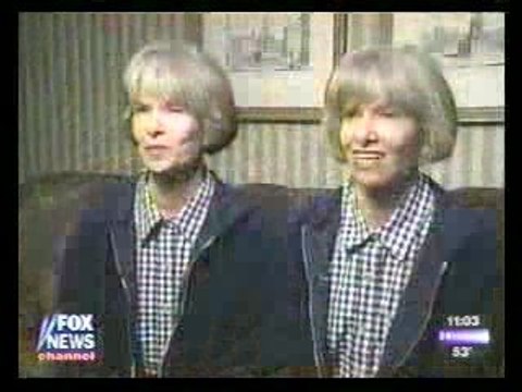 Plastic Surgery and aging Study with Twins