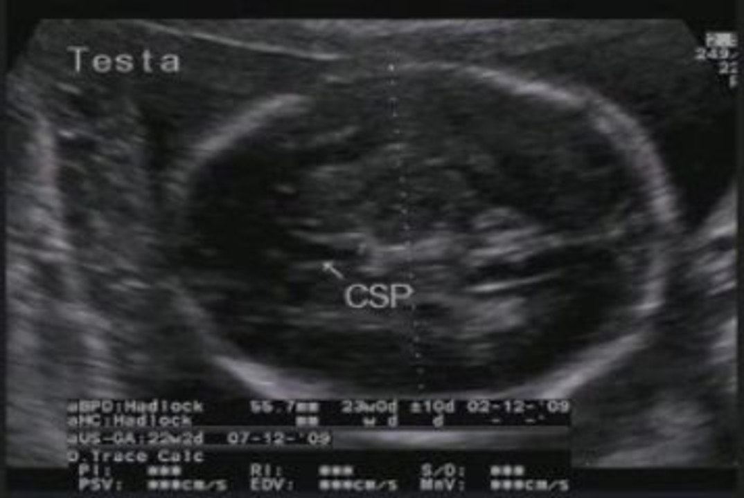 rene multicistico. ureterocele