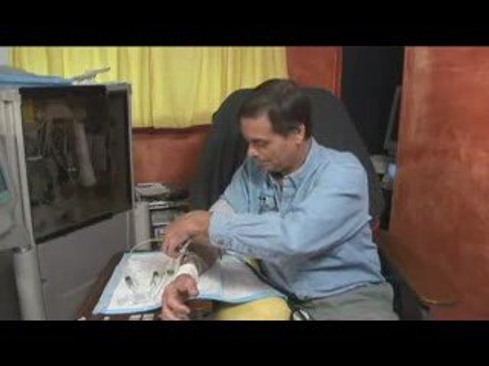 Bill doing self-dialysis & cannulation via buttonhole method