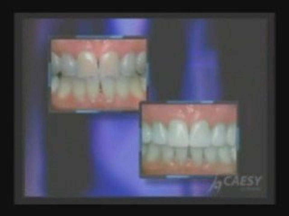Teeth Whitening | Tooth discoloration | Burbank | Dr. Sahabi
