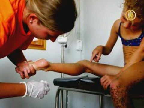 Что делать, если вас ужалила медуза