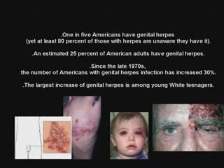 Genital Herpes Treatment
