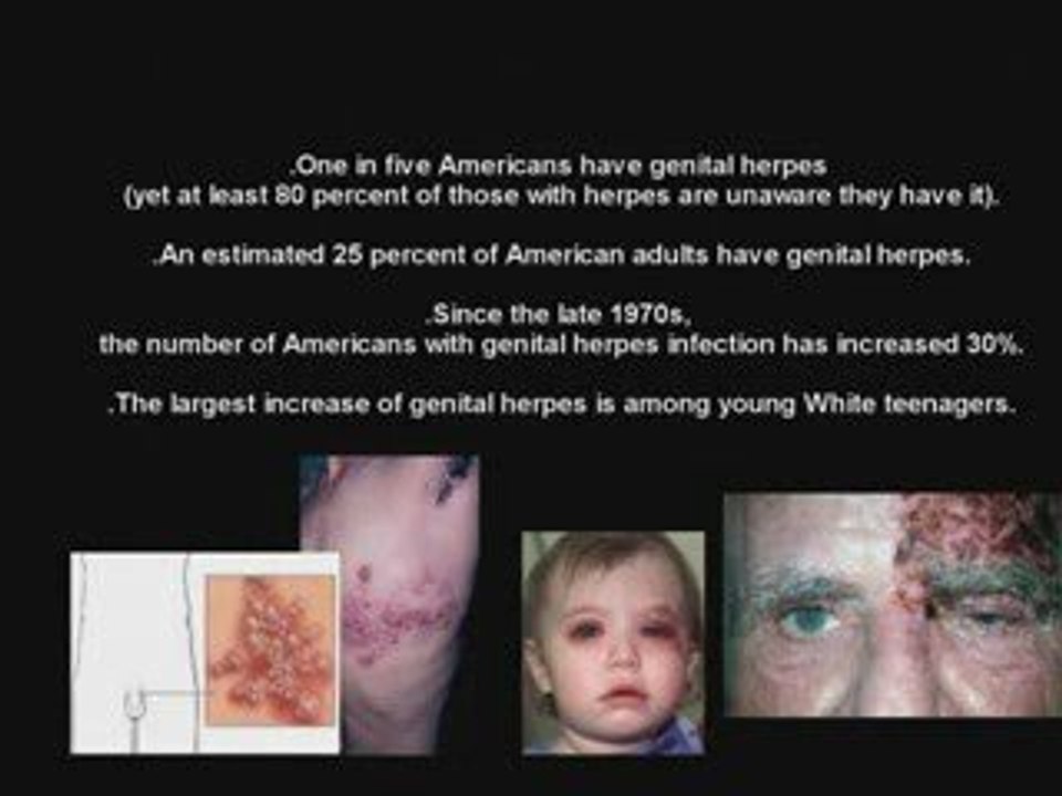 Genital Herpes