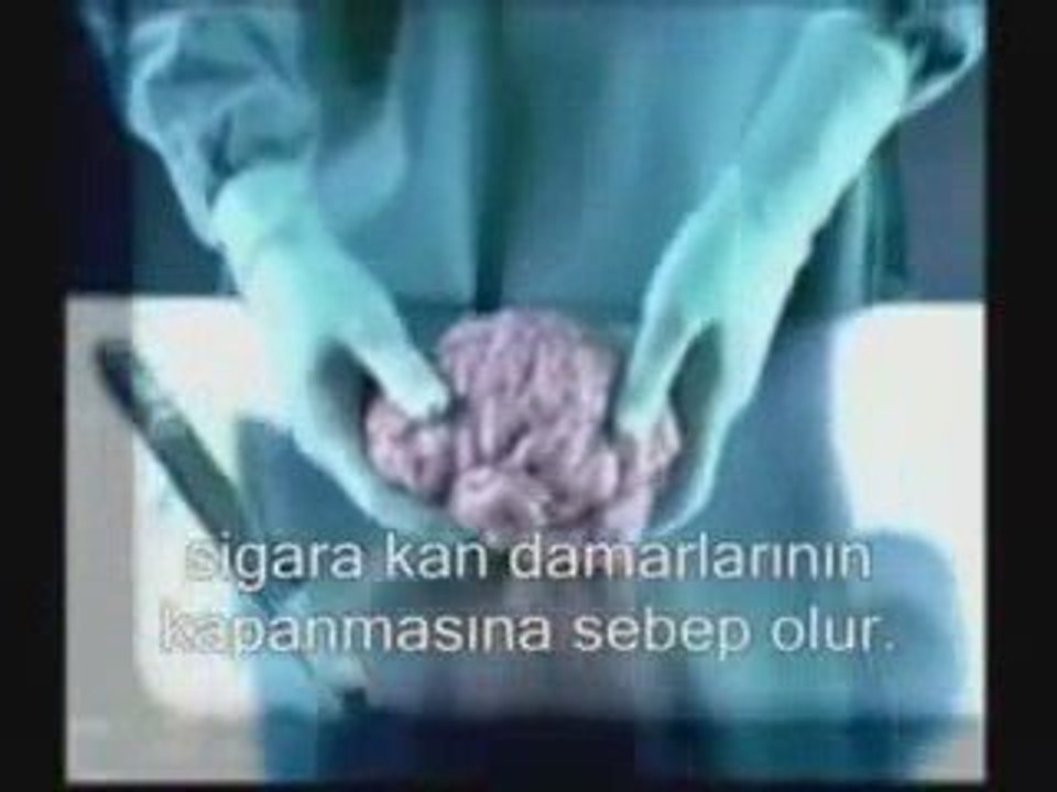 SİGARANIN ZARARLARI HİÇ BÖYLE GÖRMEDİNİZ LÜTFEN PAYLA...