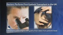 Eyelash Transplant Performed For First Time