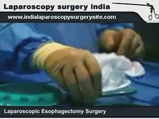 Laparoscopic Esophagectomy in India for Esophageal Cancer