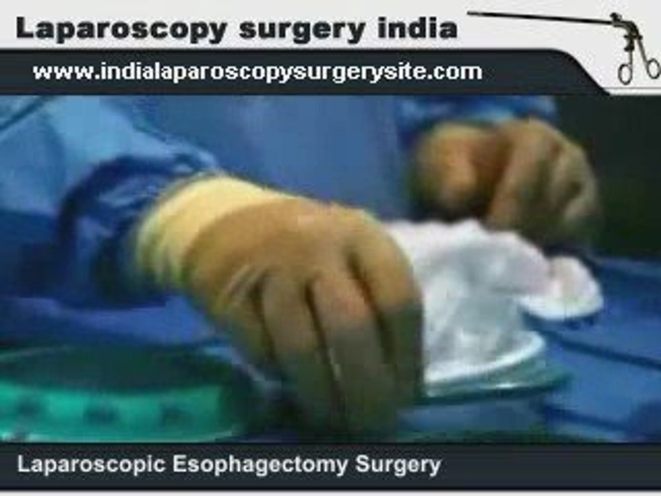 Laparoscopic Esophagectomy in India for Esophageal Cancer