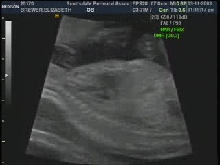 19 week ultrasound