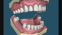 Prothèse Partielle Amovible