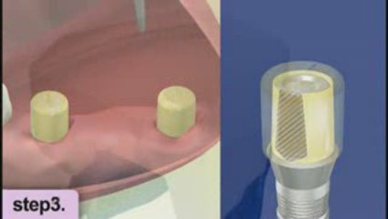 Implant - la restauration prothétique