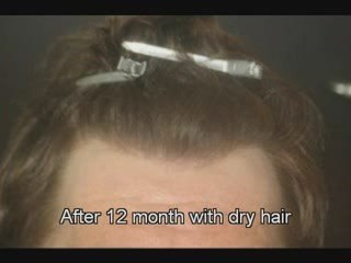 Haartransplantation Video Dr Mwamba