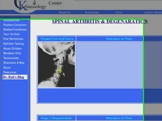 Charlotte Chiropractor Describes Spinal Arthritis