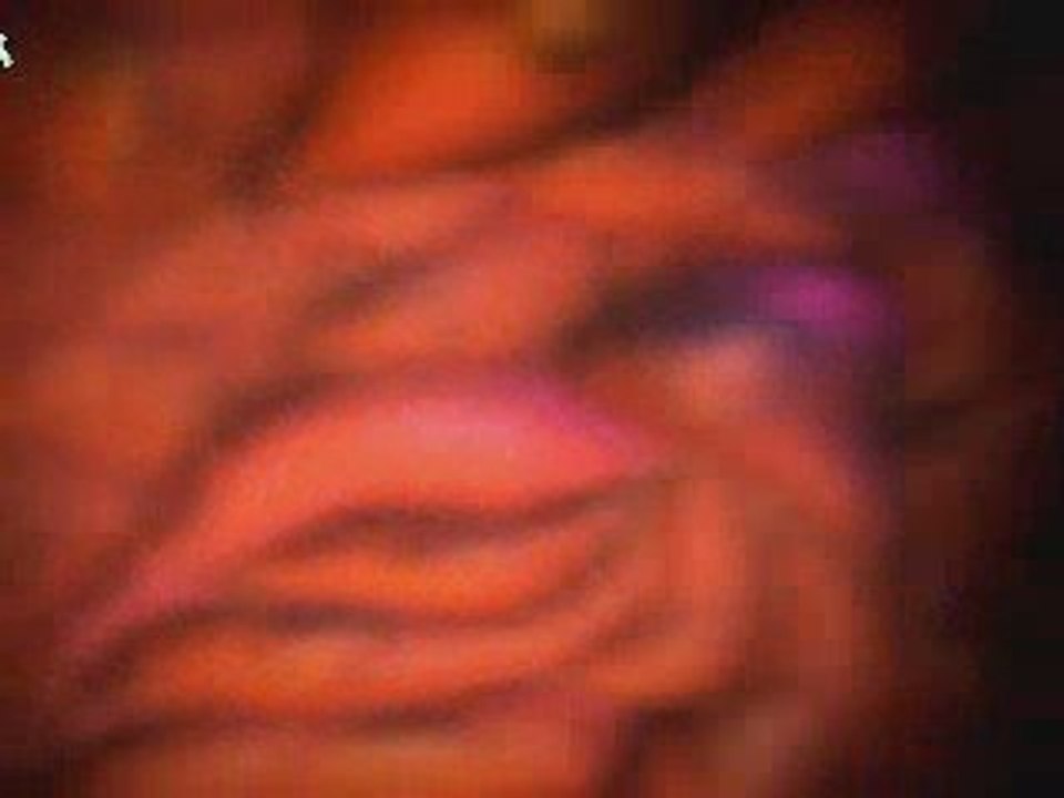 Treating Yeast Infections