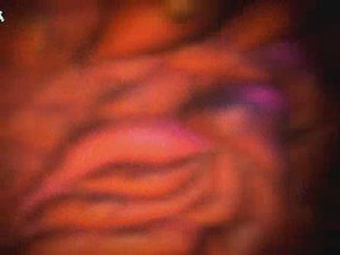 Treating Yeast Infections