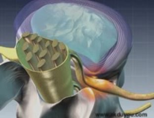 Bel Fıtıgı Ameliyatları