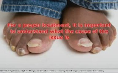 Is your finger nail fungus scaring people away? Try these am