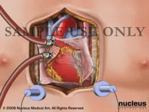 Coronary Artery Bypass Graft (CABG)