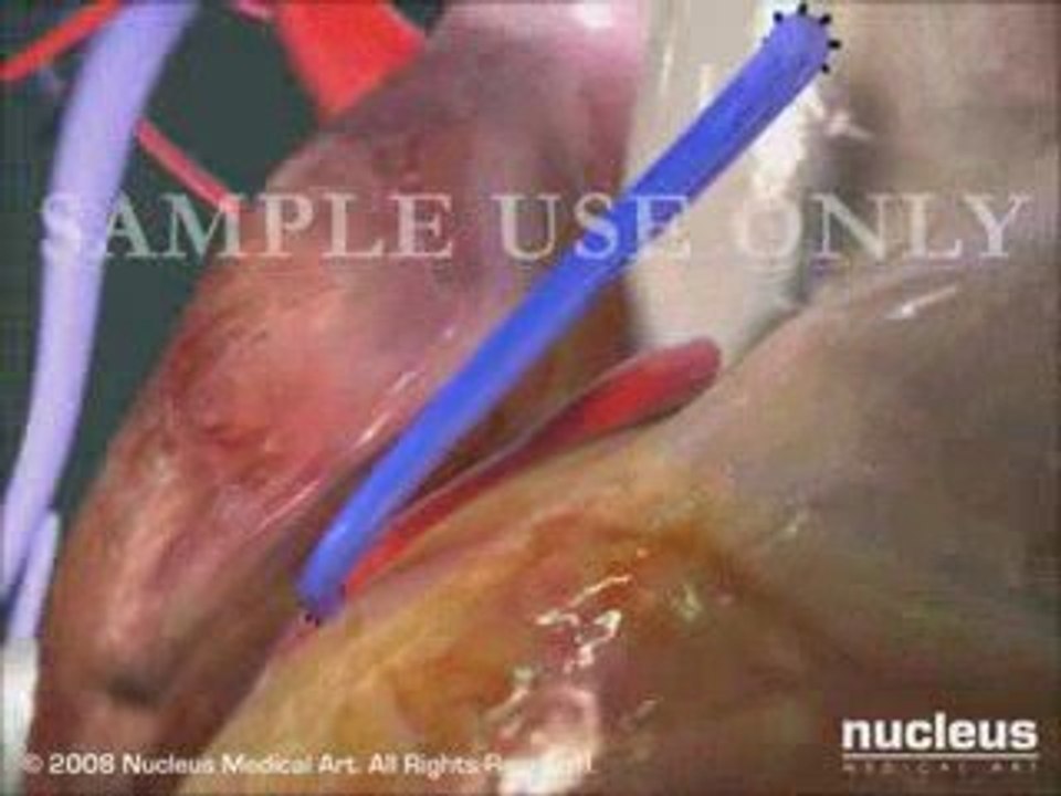 Coronary Artery Bypass Graft (CABG) Procedure- Condensed