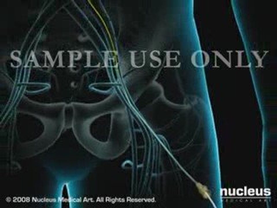 Coronary Artery Angiography (Cardiac Catheterization)- Full