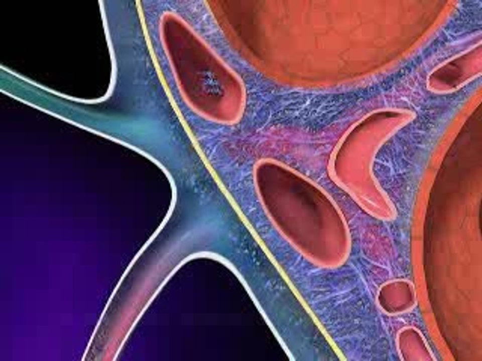 Pleural Effusion 